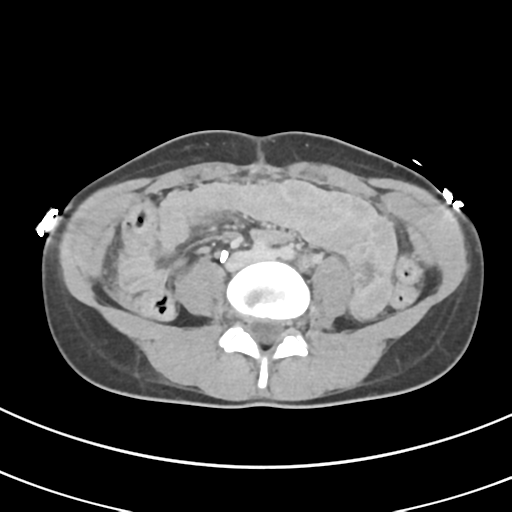 File:Abdominal multi-trauma - devascularised kidney and liver, spleen and pancreatic lacerations (Radiopaedia 34984-36486 Axial C+ delayed 48).png