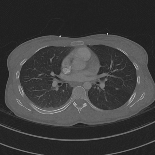 File:Abdominal multi-trauma - devascularised kidney and liver, spleen and pancreatic lacerations (Radiopaedia 34984-36486 I 44).png