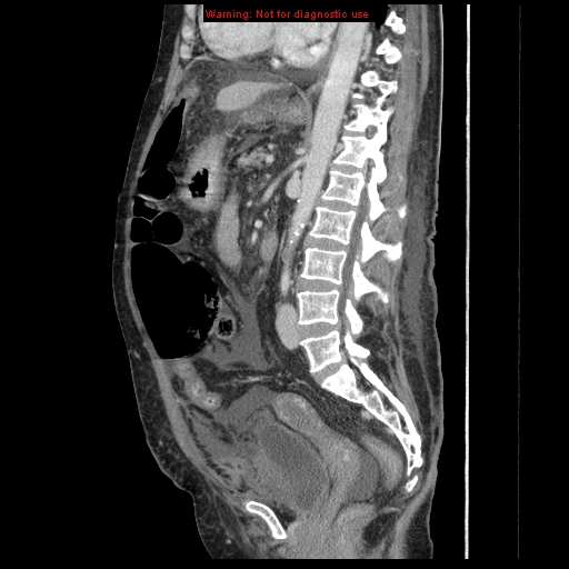Abdominal wall hematoma (Radiopaedia 9427-10112 Sagittal C+ portal venous phase 48).jpg