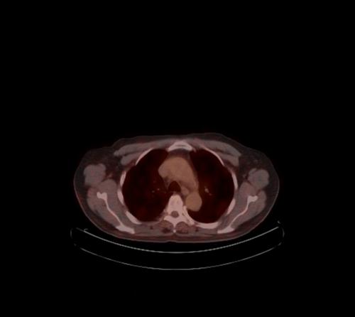 File:Abdominal wall metastasis from colorectal carcinoma (Radiopaedia 31016-31719 C 116).jpg