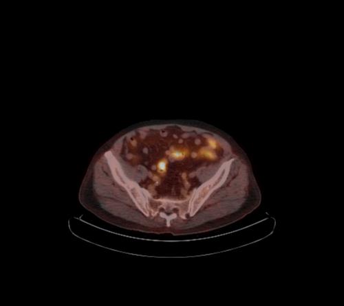 Abdominal wall metastasis from colorectal carcinoma (Radiopaedia 31016-31719 C 38).jpg