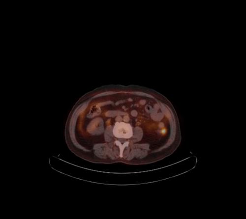 Abdominal wall metastasis from colorectal carcinoma (Radiopaedia 31016-31719 C 60).jpg