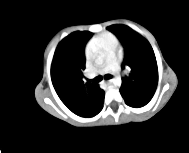 Abdominopelvic rhabdomyosarcoma (Radiopaedia 78356-90984 Axial C+ portal venous phase 17).jpg