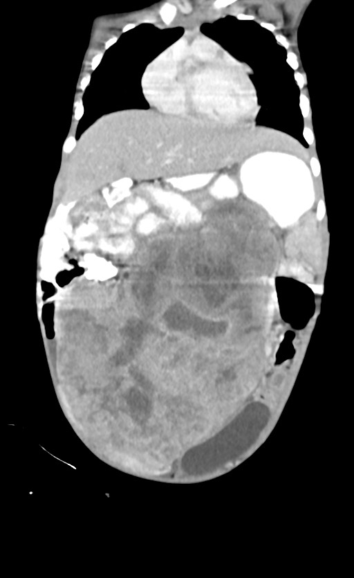 Abdominopelvic rhabdomyosarcoma (Radiopaedia 78356-90984 Coronal C+ portal venous phase 29).jpg