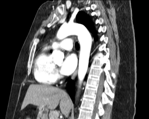 File:Aberrant right subclavian artery (Radiopaedia 67135-76475 Sagittal C+ arterial phase 18).jpg