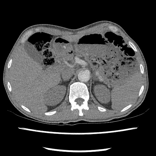 Accessory left horizontal fissure with lingular pneumonia (Radiopaedia 53763-59843 Axial C+ CTPA 91).jpg