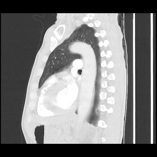 Accessory left horizontal fissure with lingular pneumonia (Radiopaedia 53763-59843 Sagittal lung window 42).jpg