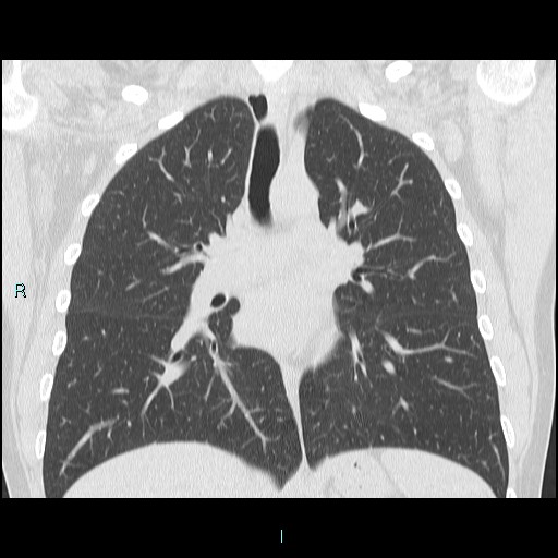 Accidental foreign body aspiration (seamstress needle) (Radiopaedia 77740-89983 Coronal lung window 30).jpg
