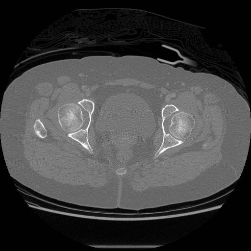 File:Acetabular fracture (Radiopaedia 13193-13212 Axial bone window 28).jpg