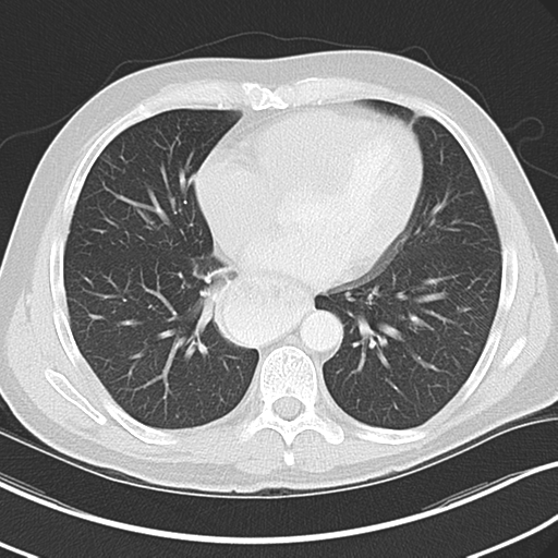 Achalasia of the cardia (Radiopaedia 38497-40595 Axial lung window 34).png