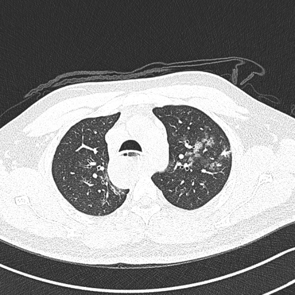 Achalasia with aspiration (Radiopaedia 55413-61845 Axial lung window 18).jpg