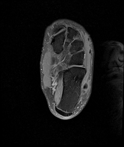 File:Achilles tendon tear (Radiopaedia 77615-89819 Axial PD fat sat 22).jpg