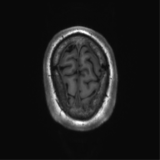 File:Achondroplasia (Radiopaedia 65109-74105 Axial T1 5).png