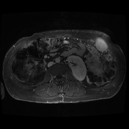 Acinar cell carcinoma of the pancreas (Radiopaedia 75442-86668 D 15).jpg