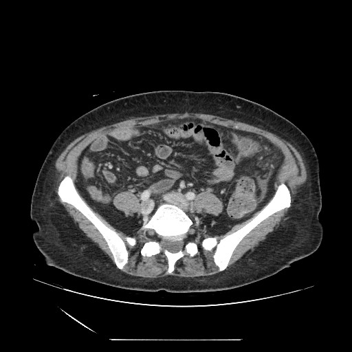 Acinar cell carcinoma of the pancreas (Radiopaedia 75442-86669 Axial C+ portal venous phase 100).jpg