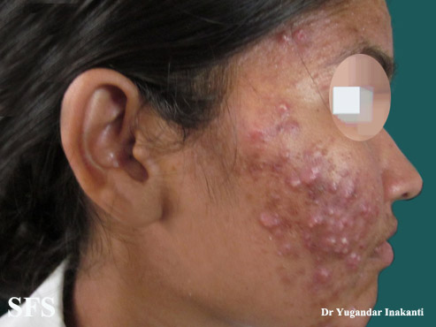 File:Acne-Topical Corticosteroids (Dermatology Atlas 1).jpg