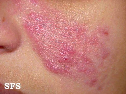 File:Acne Rosacea (Dermatology Atlas 3).jpg
