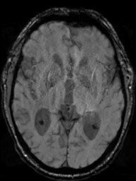 File:Acoustic schwannoma (Radiopaedia 55729-62281 Axial SWI 25).png