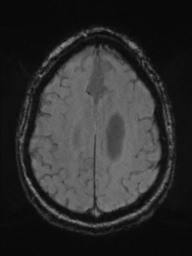 Acoustic schwannoma (Radiopaedia 55729-62281 Axial SWI 40).png