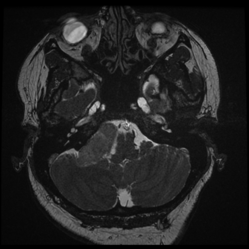Acoustic schwannoma (Radiopaedia 57574-64536 Axial T2 19).png
