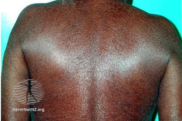 File:Acquired ichthyosis in kava drinker (DermNet NZ doctors-scaly-rashes-images-ichth6).jpg