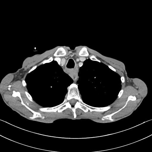 File:Acquired tracheoesophageal fistula (Radiopaedia 57747-65042 Axial C+ portal venous phase 19).jpg