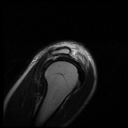 File:Acromioclavicular joint dislocation (Radiopaedia 14218-14076 Sagittal T2 1).jpg