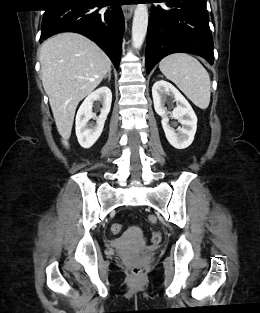 Active Crohn disease (Radiopaedia 59394-66750 Coronal C+ portal venous phase 48).jpg