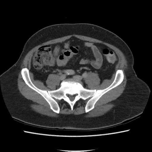 File:Active colonic bleed on CT (Radiopaedia 49765-55025 Axial C+ delayed 59).jpg