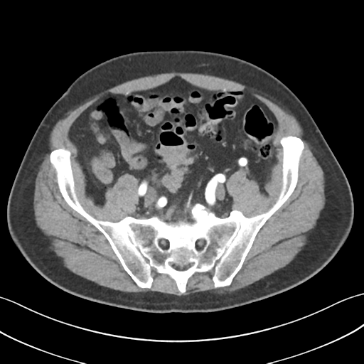 Active diverticular hemorrhage (Radiopaedia 39415-41725 Axial C+ arterial phase 50).png