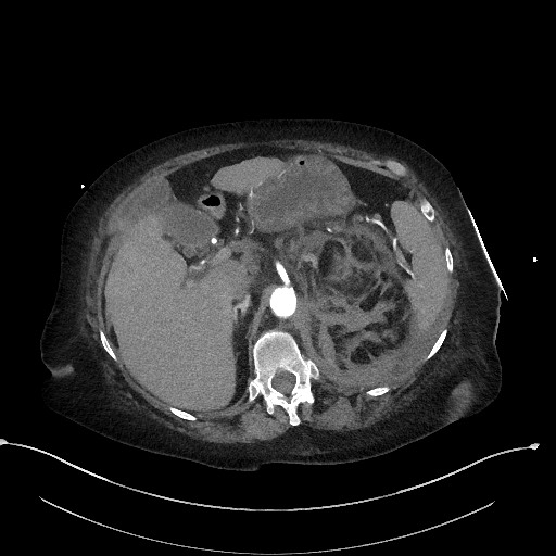 Active renal extravasation with large subcapsular and retroperitoneal hemorrhage (Radiopaedia 60975-68796 Axial C+ arterial phase 56).jpg