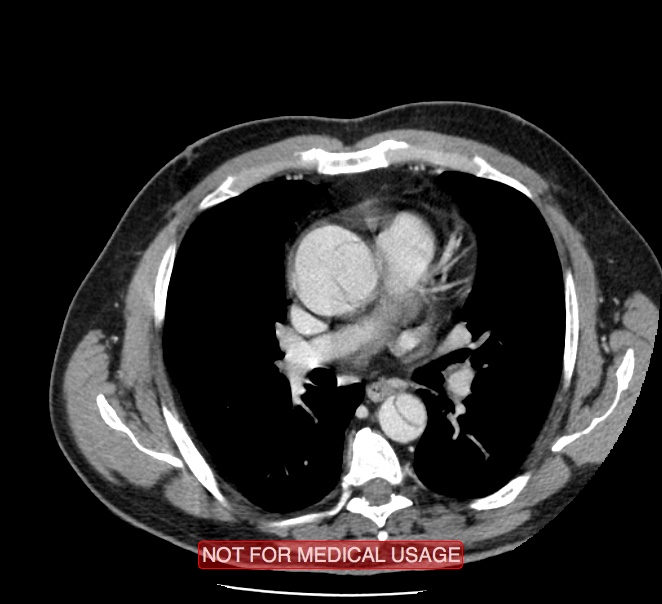 Acute aortic dissection - Stanford type A (Radiopaedia 40661-43285 Axial C+ portal venous phase 24).jpg