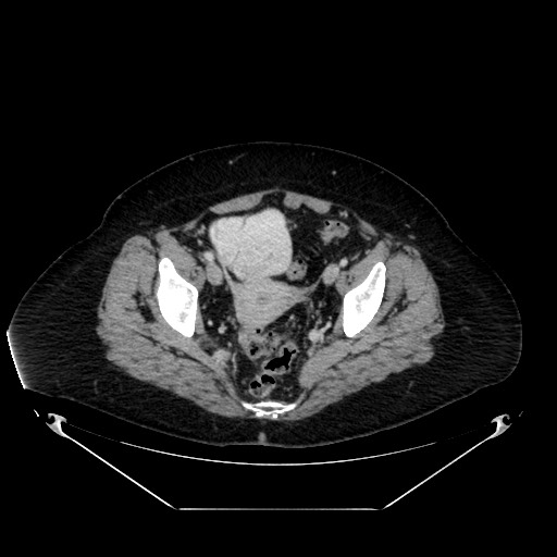 File:Acute appendicitis, heterotaxy syndrome (Radiopaedia 66884-76202 Axial C+ portal venous phase 112).jpg