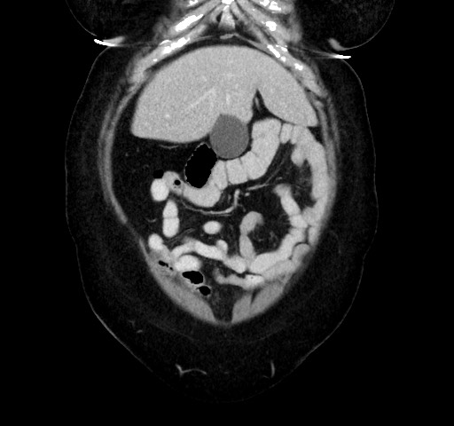 Acute appendicitis, heterotaxy syndrome (Radiopaedia 66884-76202 Coronal C+ portal venous phase 23).jpg