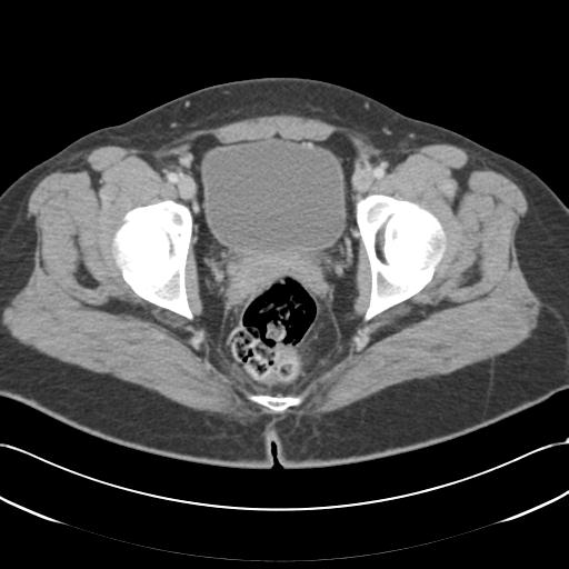 Acute appendicitis (Radiopaedia 30297-30934 Axial C+ portal venous phase 76).jpg