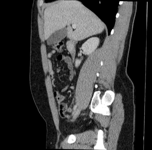 Acute appendicitis (Radiopaedia 38255-40270 Sagittal C+ portal venous phase 31).jpg