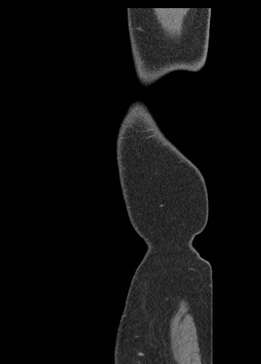Acute appendicitis (Radiopaedia 48511-53463 Sagittal C+ portal venous phase 133).jpg