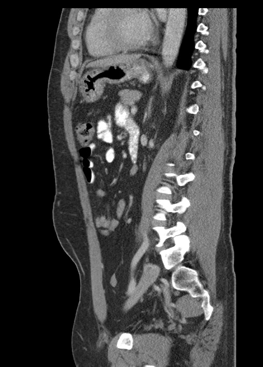 Acute appendicitis (Radiopaedia 48511-53463 Sagittal C+ portal venous phase 82).jpg