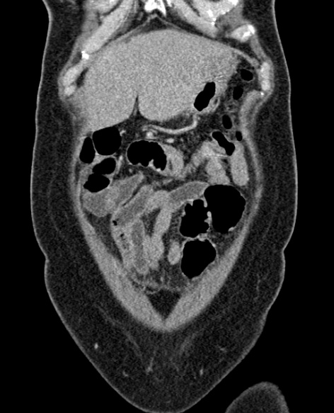 File:Acute appendicitis (Radiopaedia 48792-53822 Coronal C+ portal venous phase 54).jpg