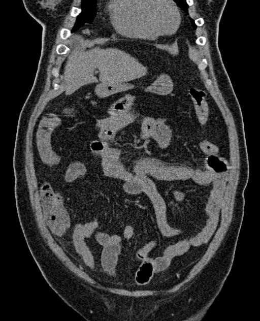 Acute appendicitis (Radiopaedia 58627-65818 Coronal non-contrast 29).jpg