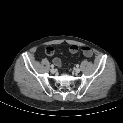 File:Acute appendicitis (Radiopaedia 66513-75790 Axial C+ portal venous phase 70).jpg