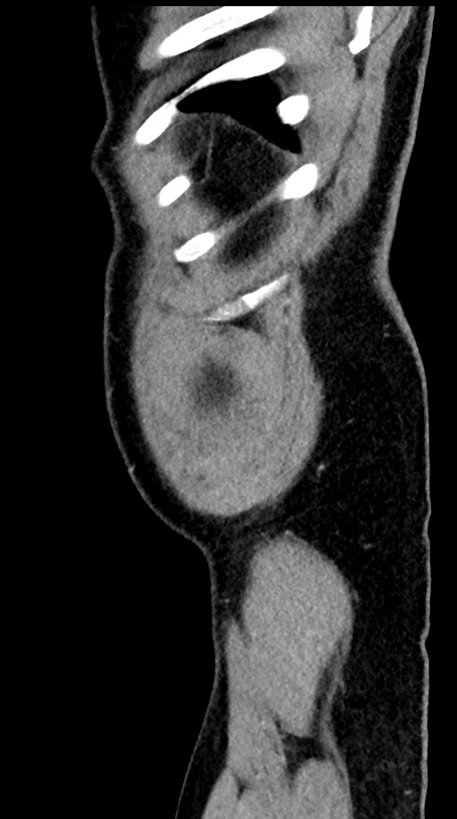 Acute appendicitis (Radiopaedia 77016-88960 Sagittal C+ portal venous phase 9).jpg