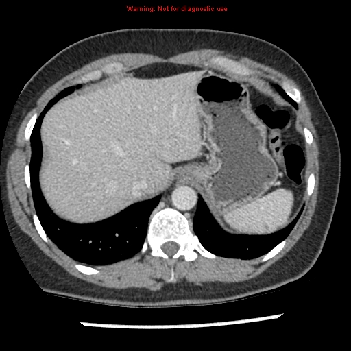 File:Acute appendicitis (Radiopaedia 7966-8812 C+ portal venous phase 1).jpg