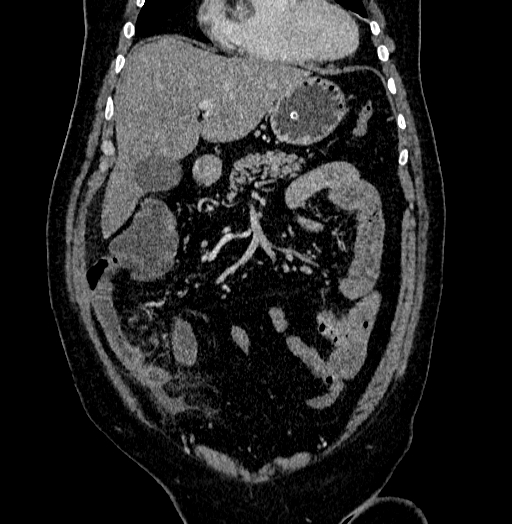 File:Acute appendicitis (Radiopaedia 79950-93224 Coronal C+ portal venous phase 28).jpg