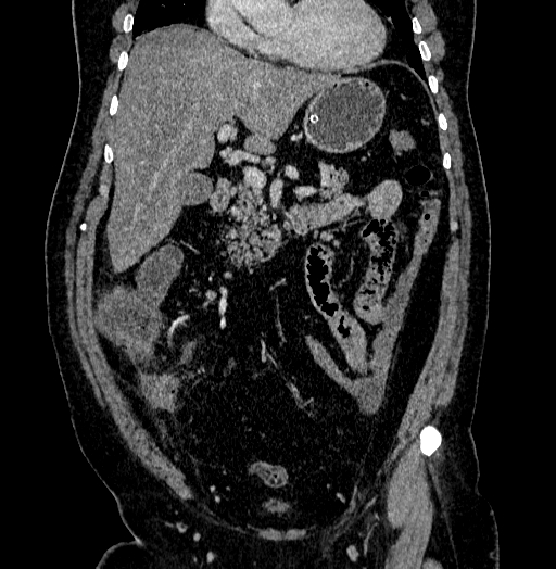 Acute appendicitis (Radiopaedia 79950-93224 Coronal C+ portal venous phase 36).jpg