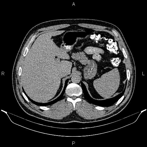 File:Acute appendicitis (Radiopaedia 84780-100240 Axial C+ delayed 23).jpg