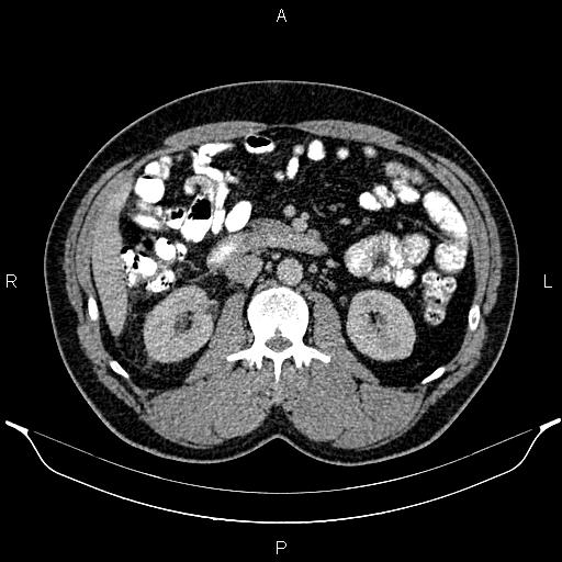 Acute appendicitis (Radiopaedia 84780-100240 Axial C+ portal venous phase 46).jpg
