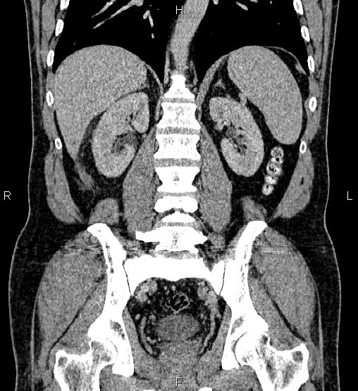 Acute appendicitis (Radiopaedia 84780-100240 Coronal C+ portal venous phase 55).jpg