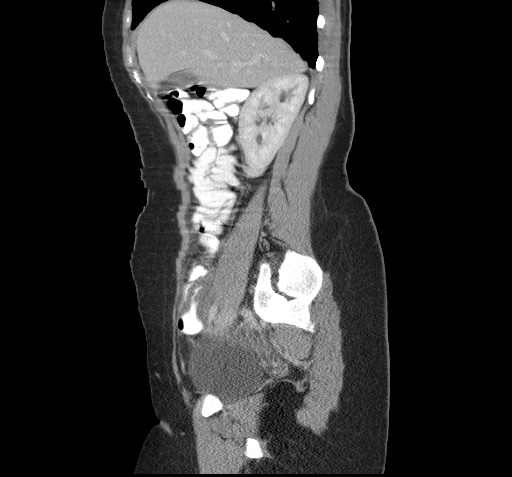 File:Acute appendicitis (Radiopaedia 9417-10099 Sagittal C+ portal venous phase 12).jpg