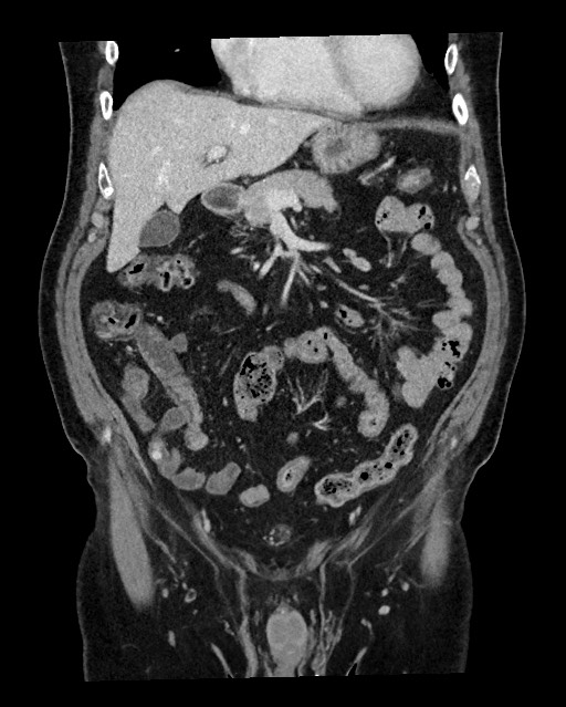 Acute appendicitis - large appendicoliths (Radiopaedia 61805-69820 Coronal C+ portal venous phase 48).jpg